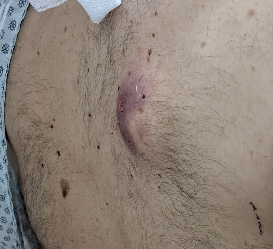 Caso clínico de Absceso
