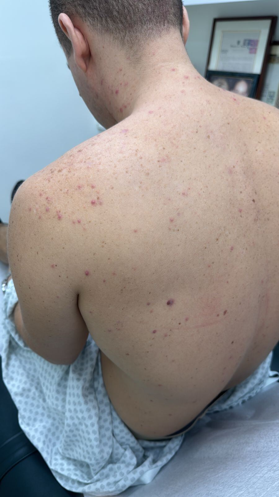 Acné por corticoides y complejo B: imagen antes