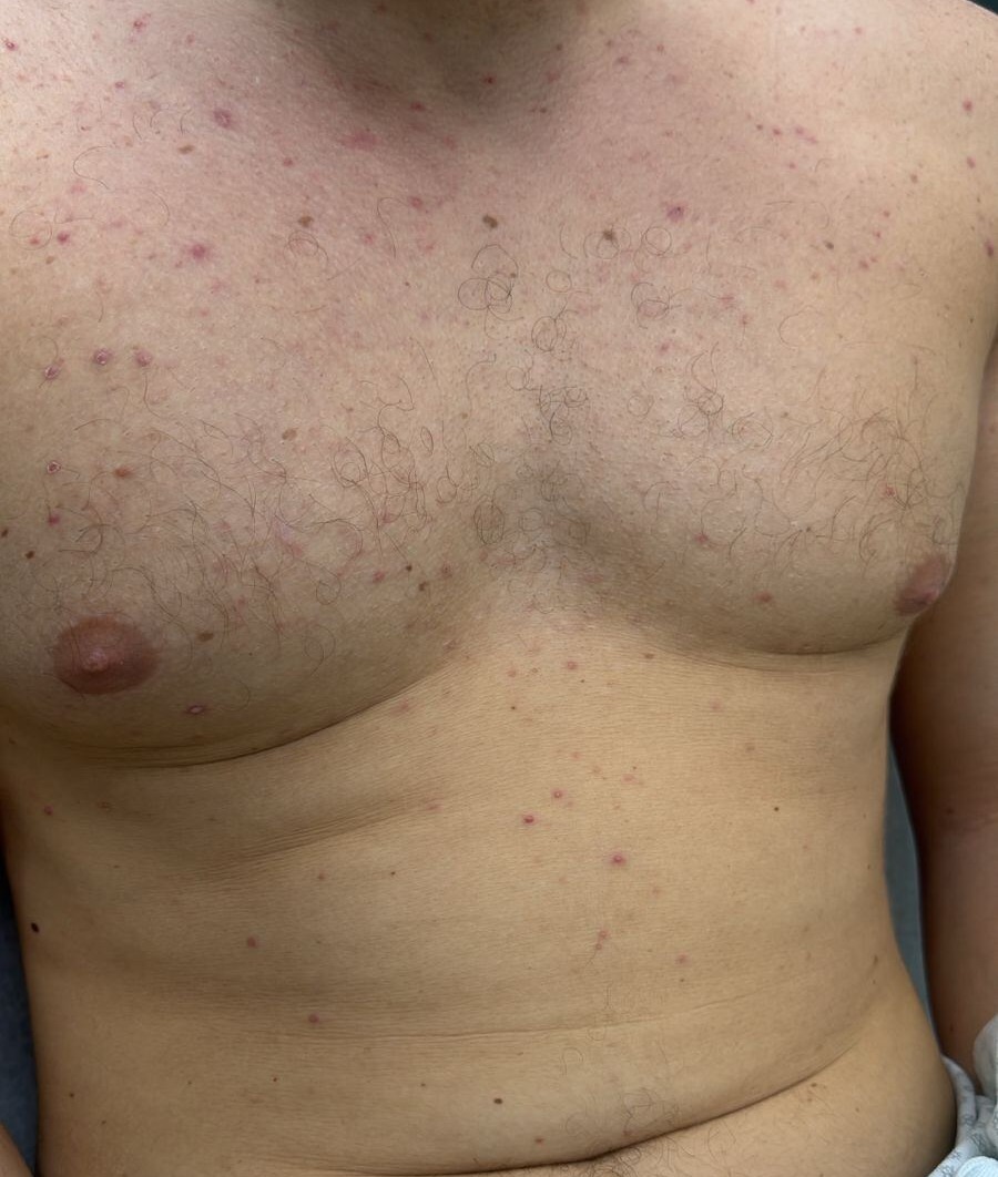 Acné por corticoides y complejo B: imagen después