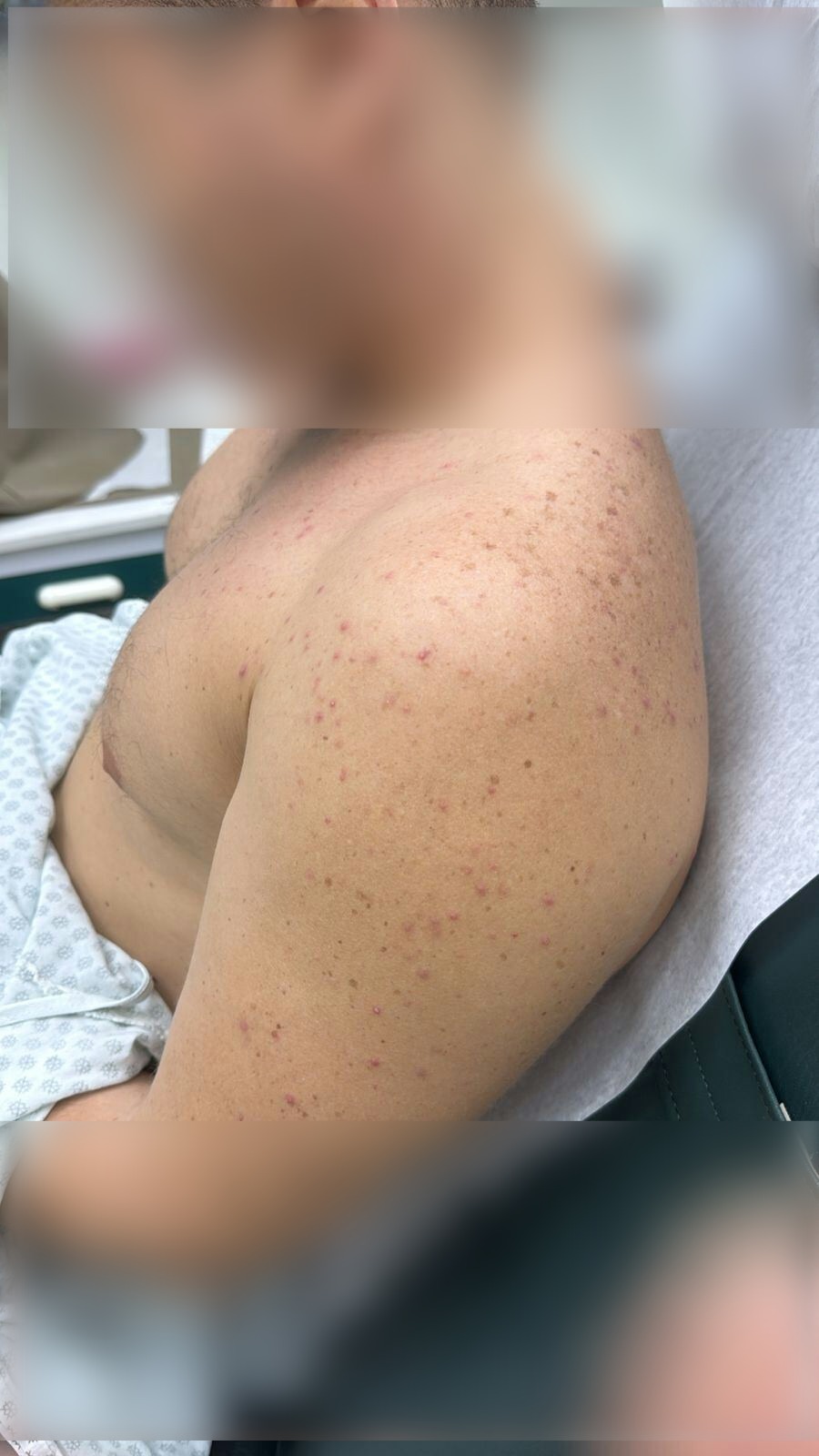 Caso clínico de Acné por corticoides y complejo B