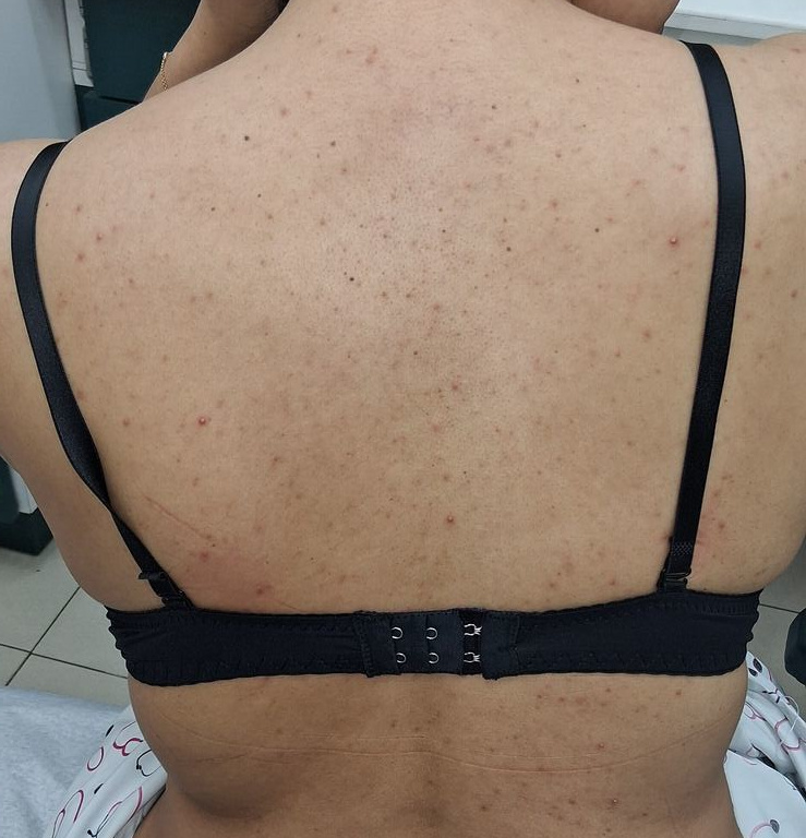 Caso clínico de Acné por esteroides