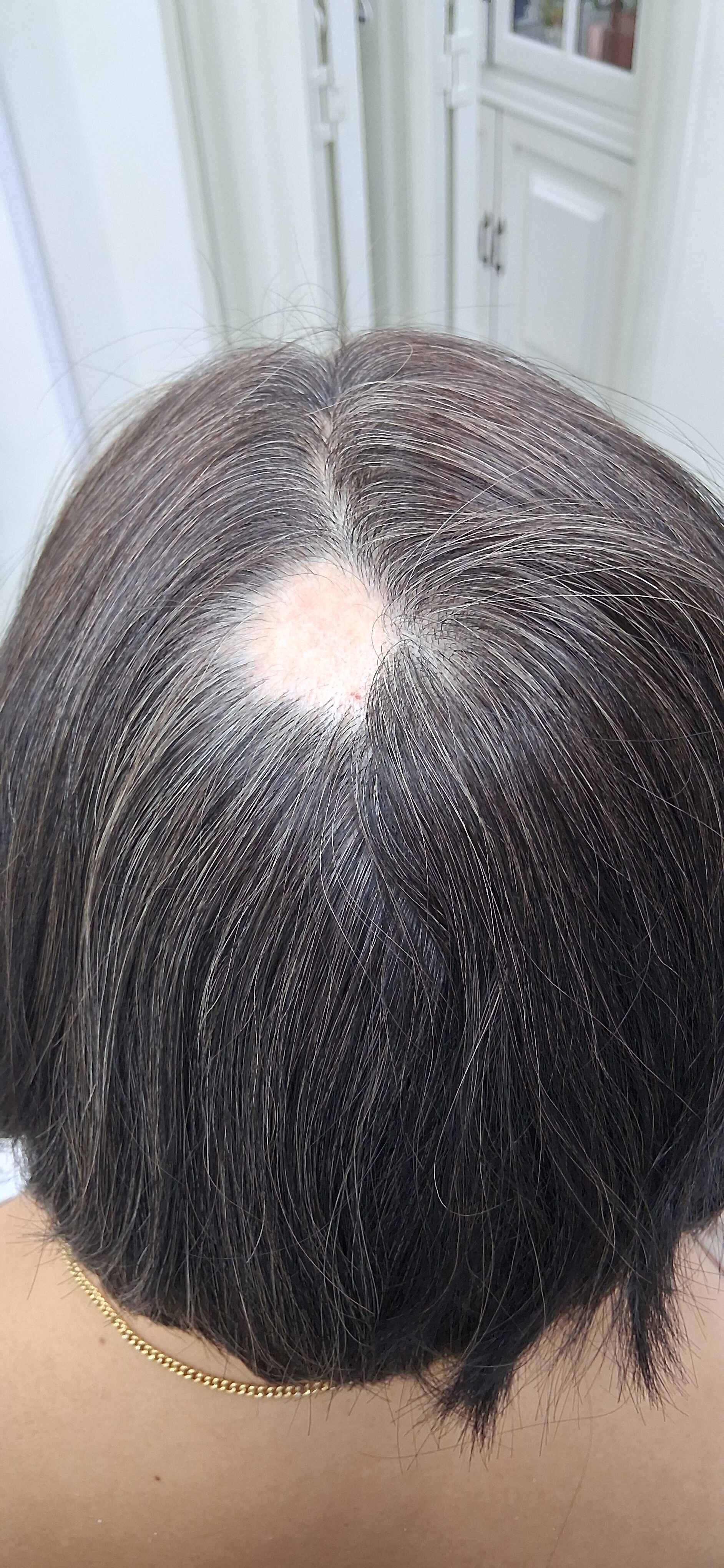 Alopecia areata: imagen después