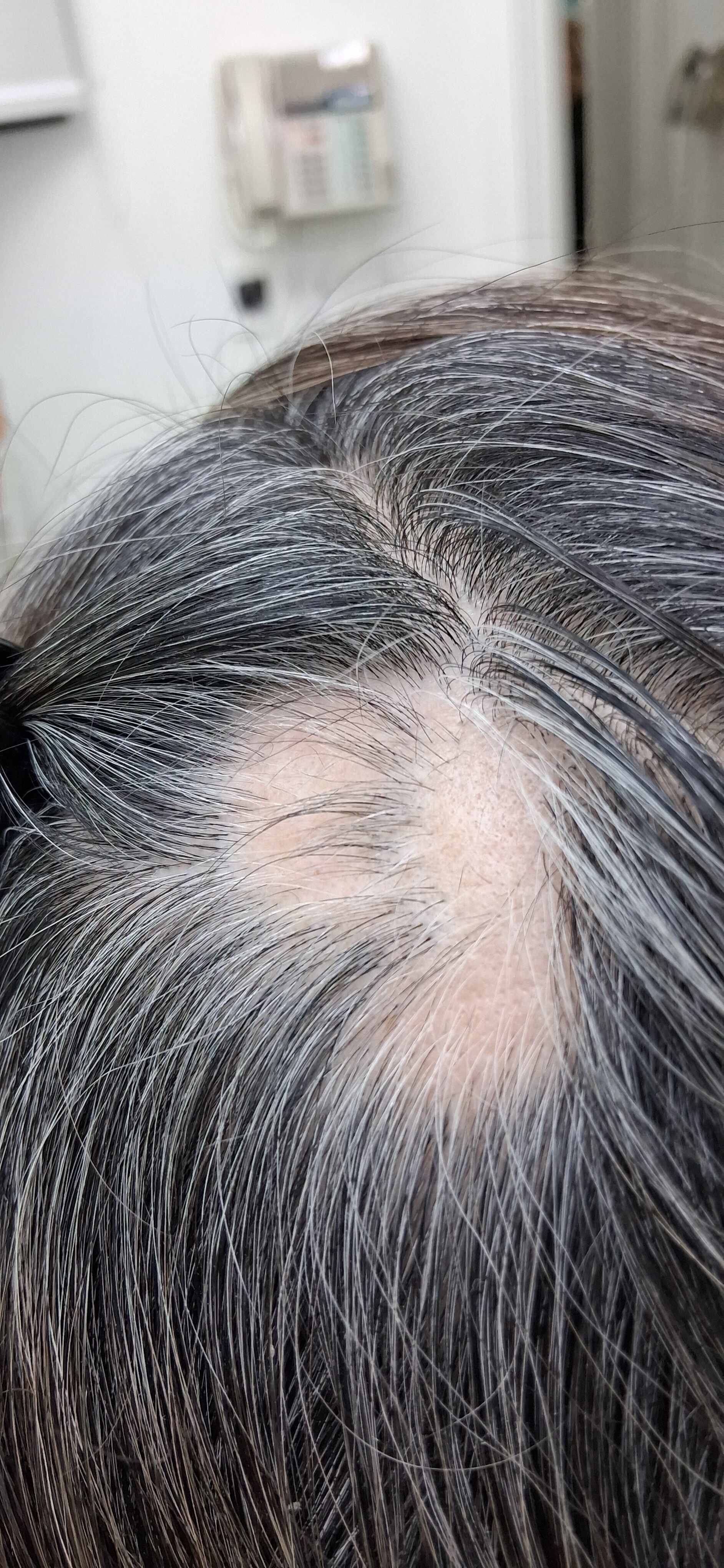 Caso clínico de Alopecia areata