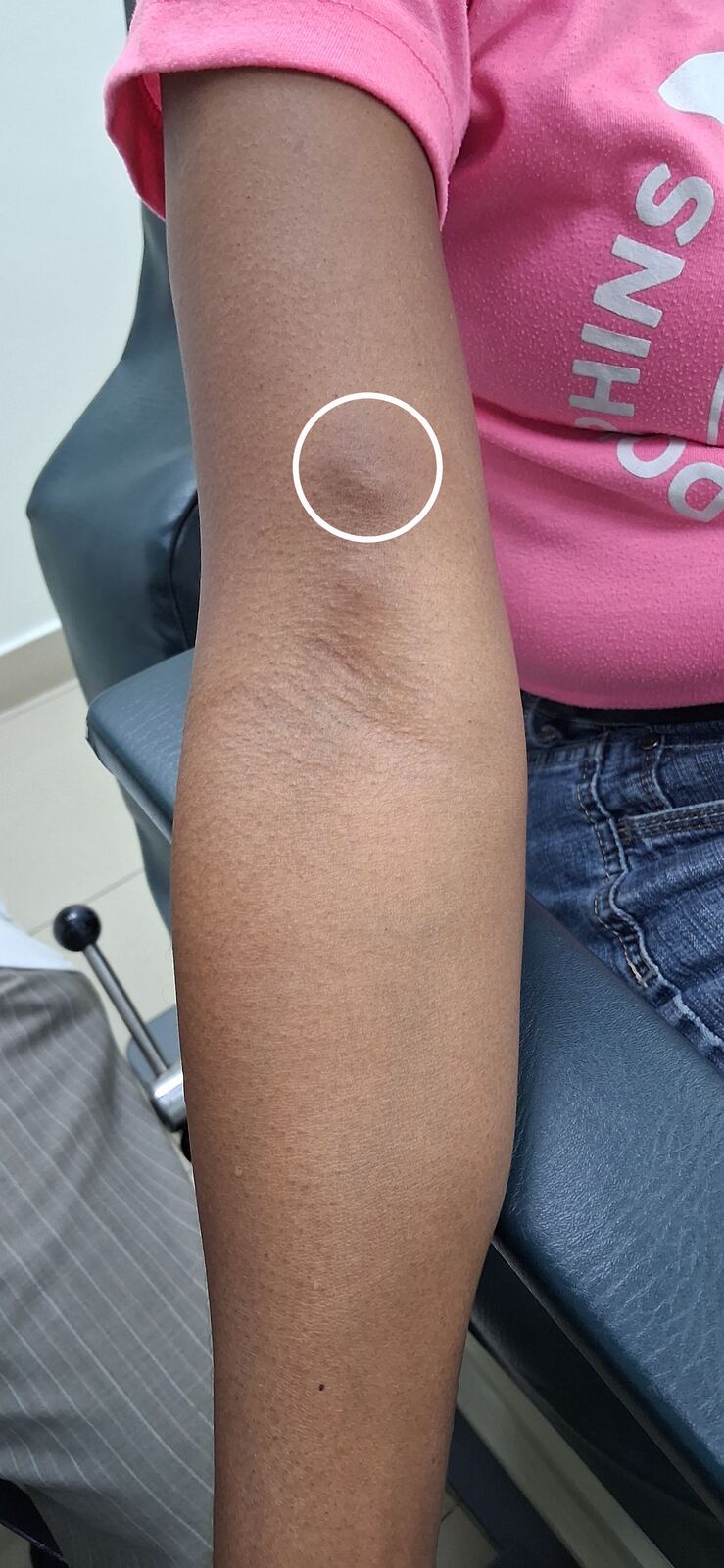 Calcinosis cutis, polimiositis y dermatomiositis: imagen antes