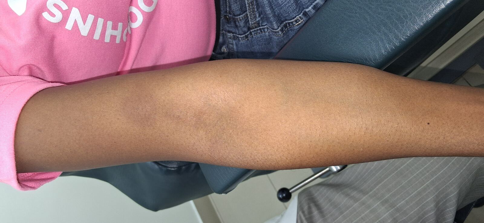 Caso clínico de Calcinosis cutis, polimiositis y dermatomiositis