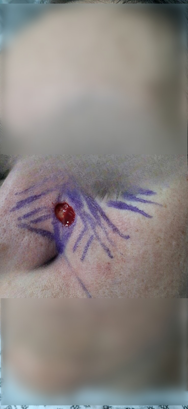 Carcinoma basocelular: imagen antes