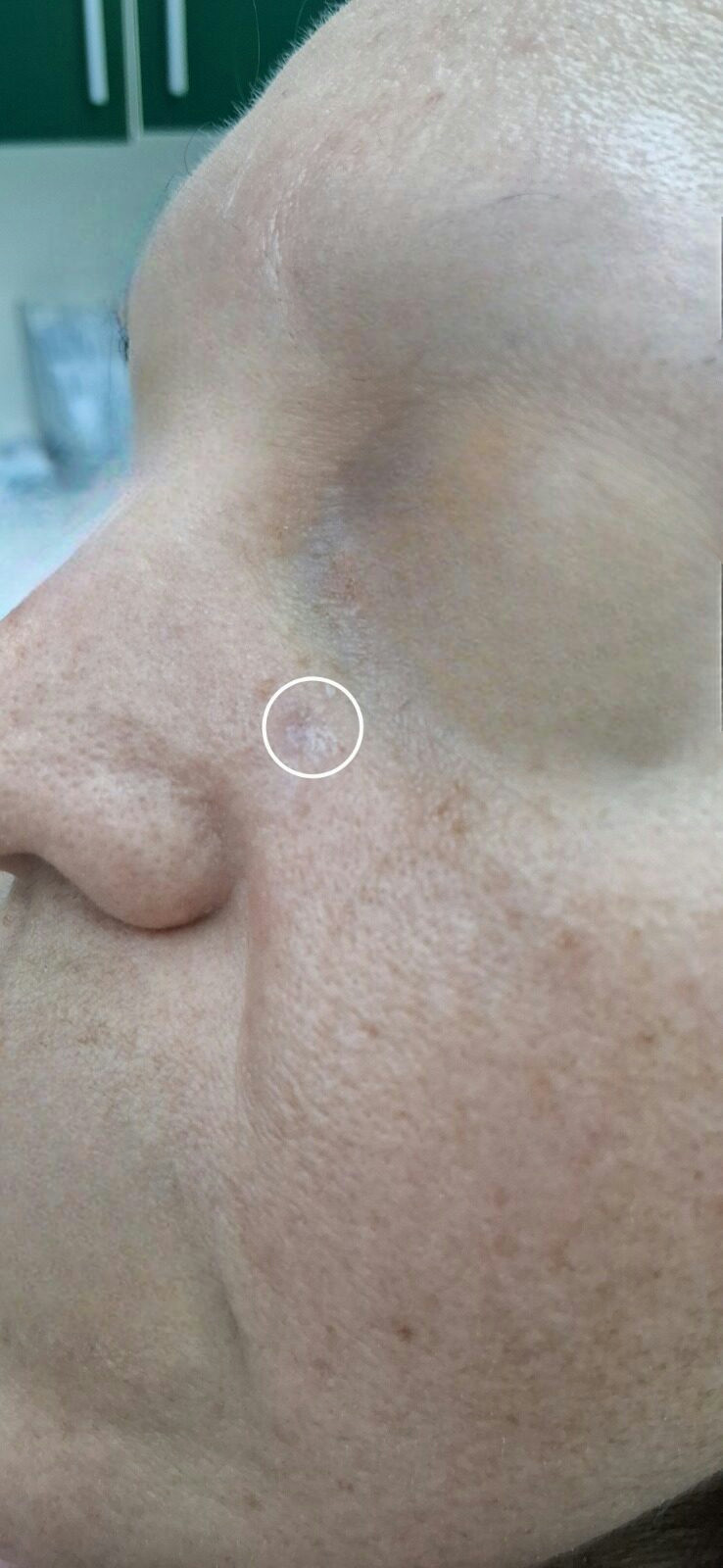 Carcinoma basocelular: imagen después