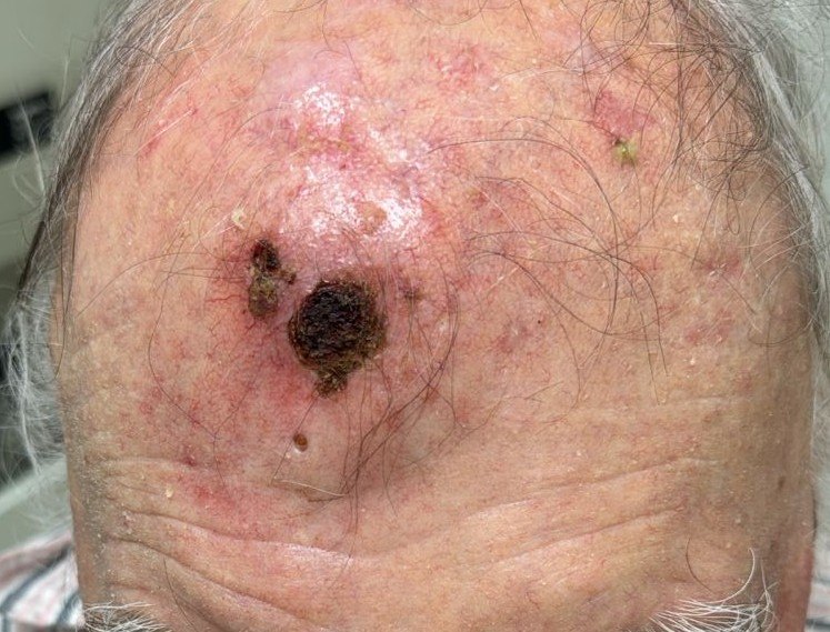 Carcinoma escamoso: imagen antes