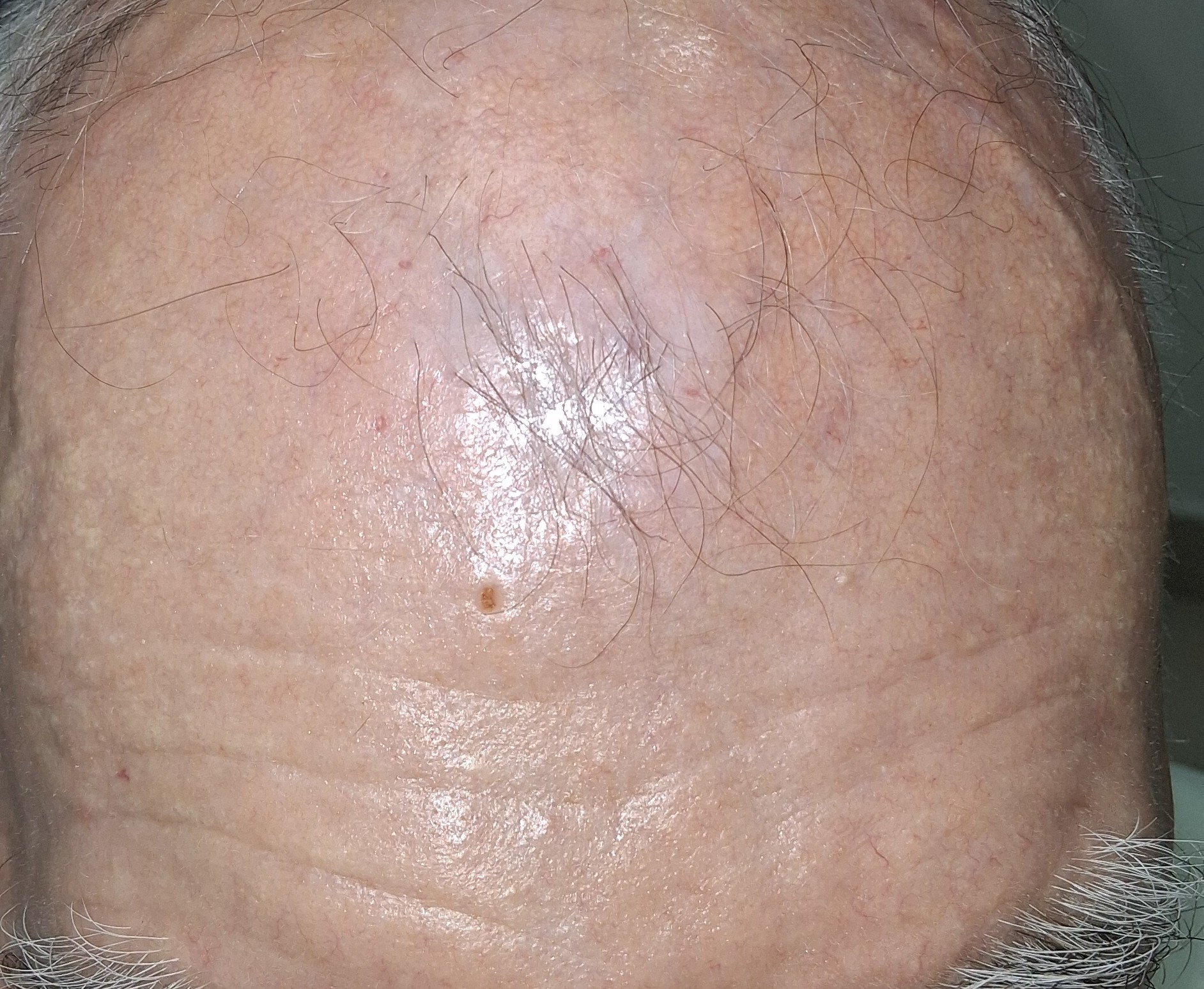 Carcinoma escamoso: imagen después