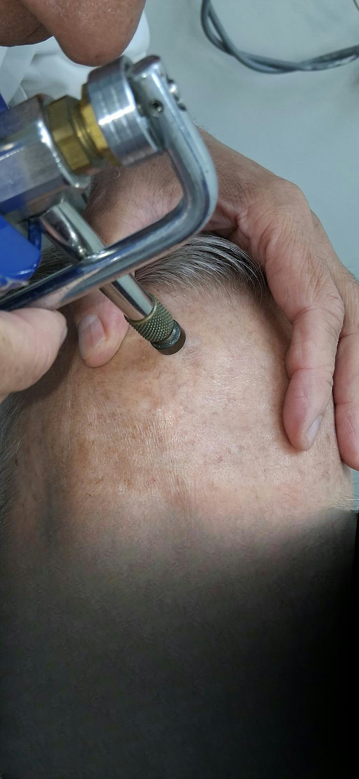 Carcinoma escamoso in situ: imagen antes