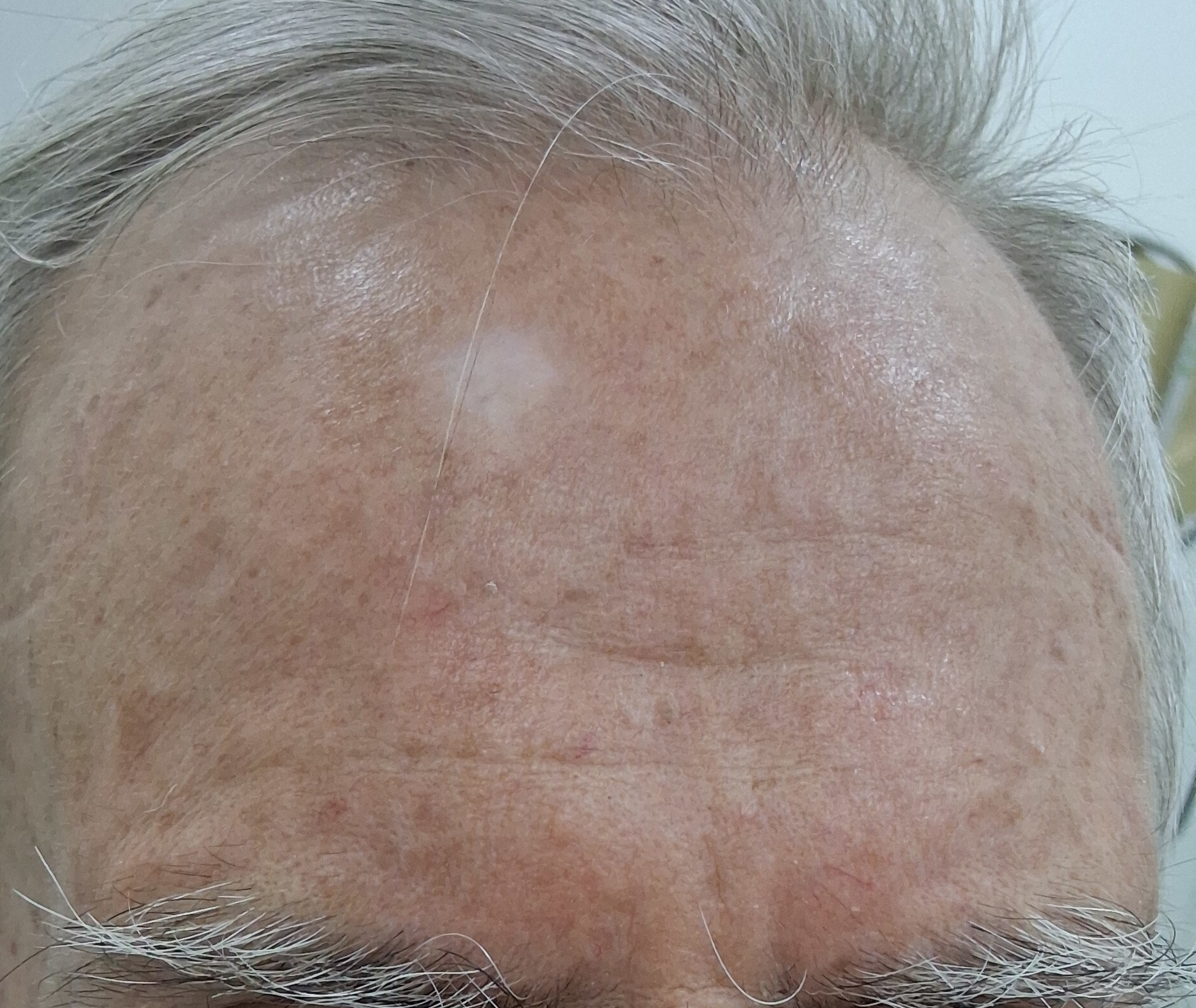 Carcinoma escamoso in situ: imagen después