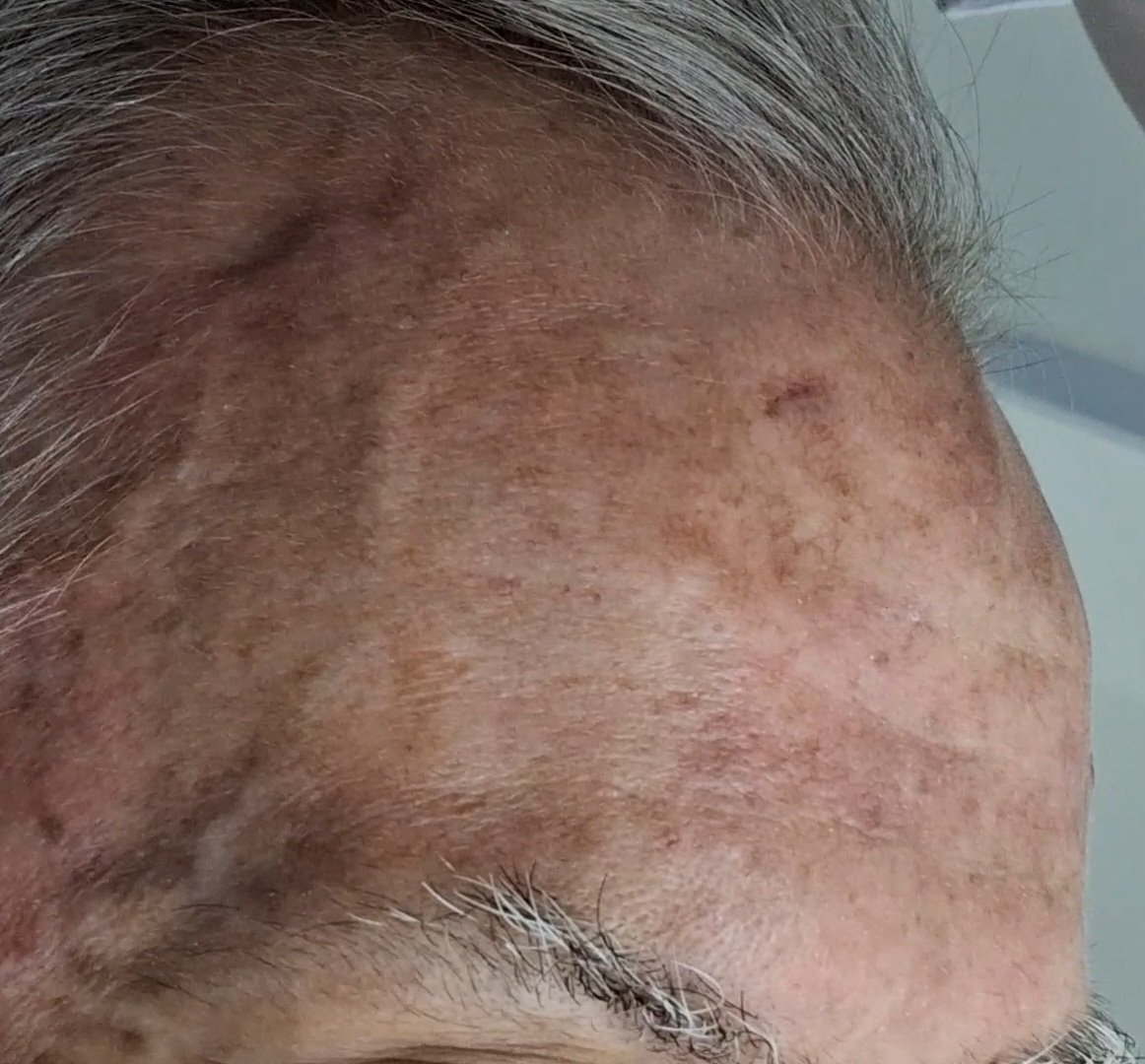 Caso clínico de Carcinoma escamoso in situ