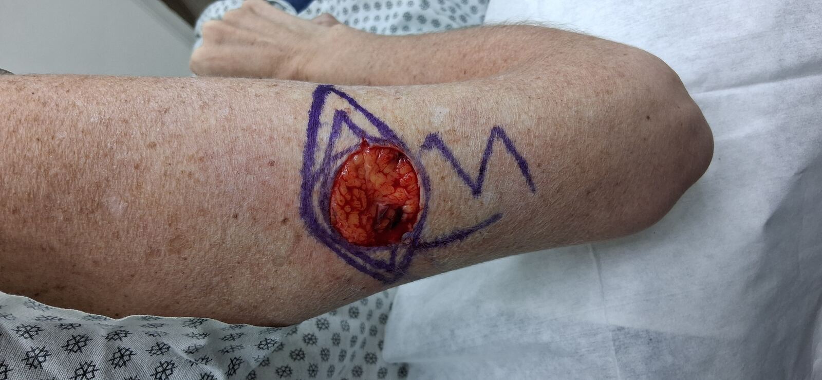 Carcinoma escamoso vs carcinoma basocelular: imagen después