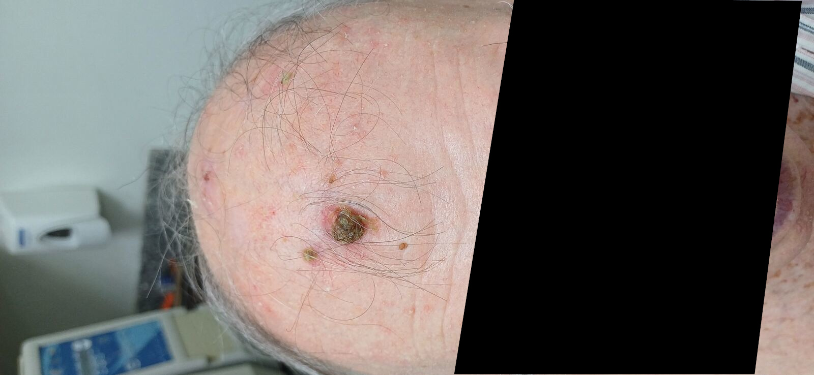 Caso clínico de Carcinoma escamoso