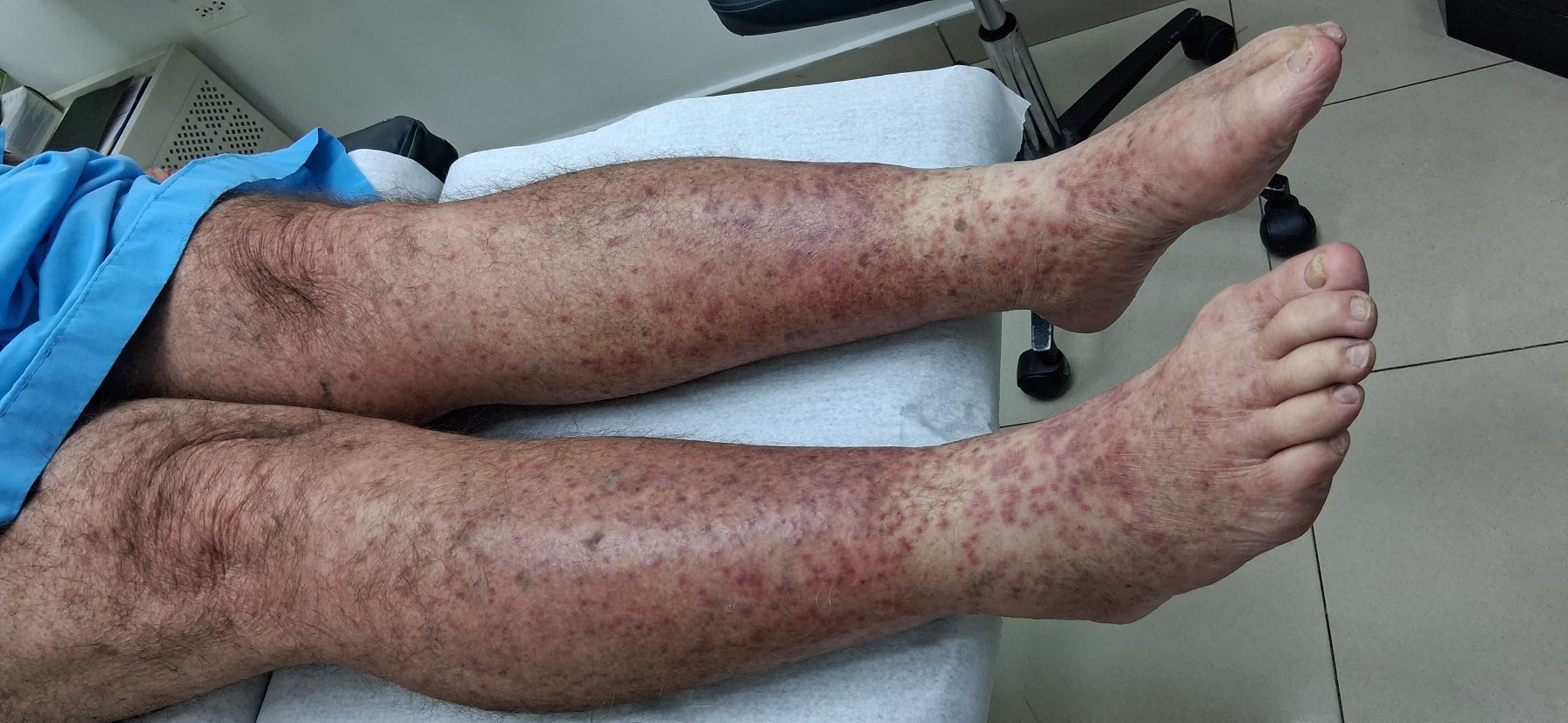 Celulitis: imagen antes