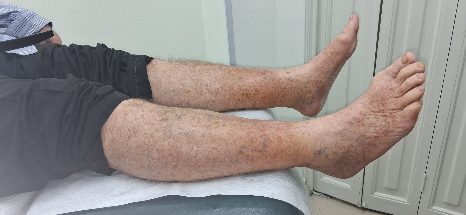 Celulitis: imagen después