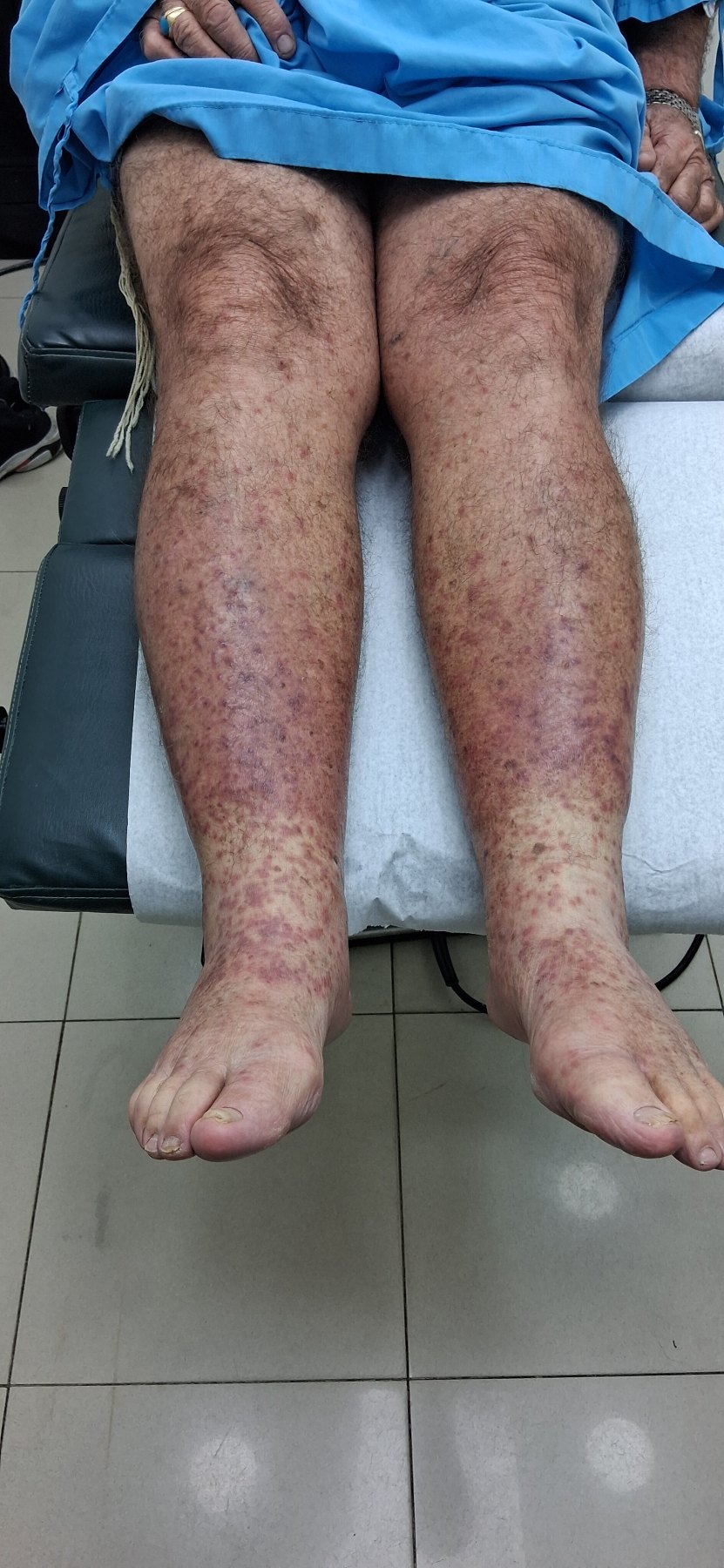 Caso clínico de Celulitis