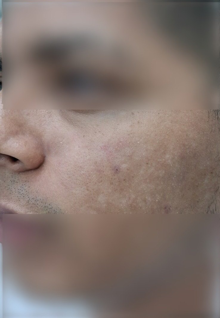 Demodex: imagen antes