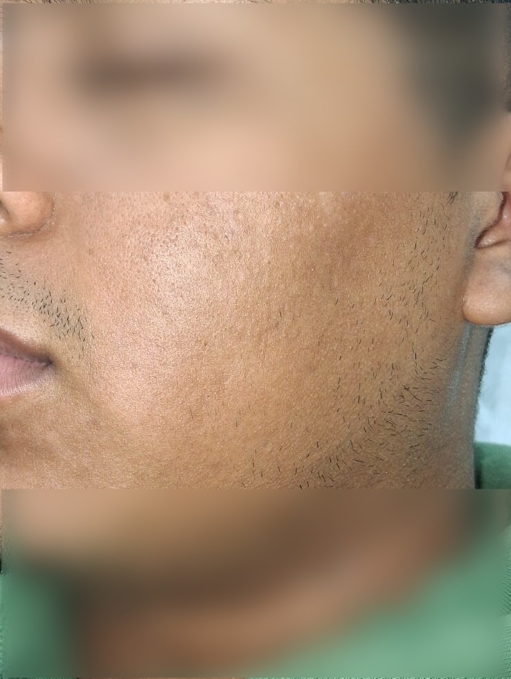 Demodex: imagen después