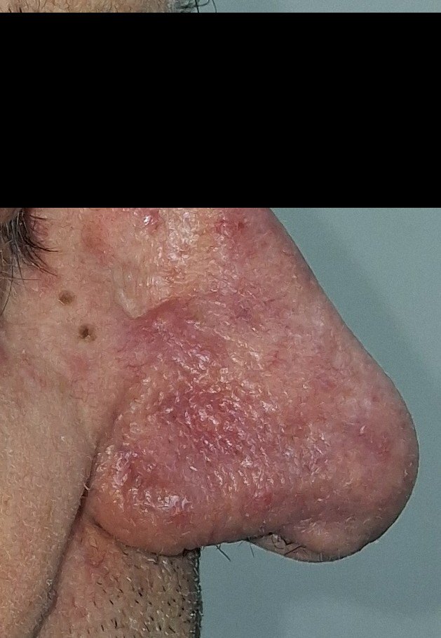 Demodex y dermatitis seborreica: imagen antes