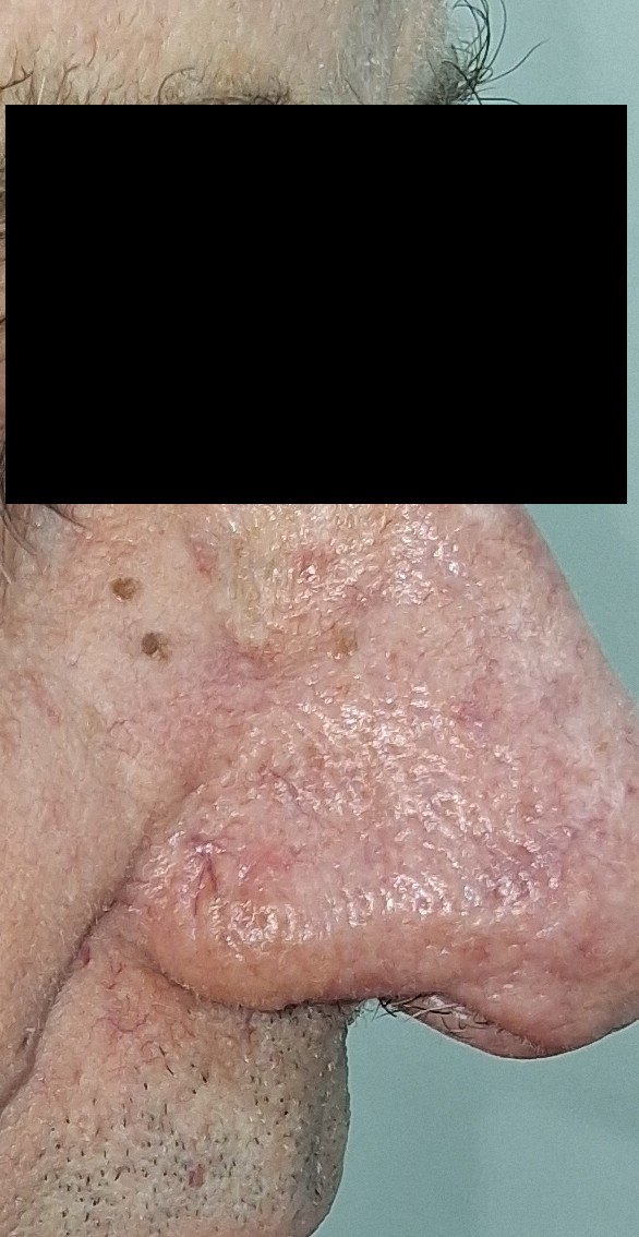 Demodex y dermatitis seborreica: imagen después