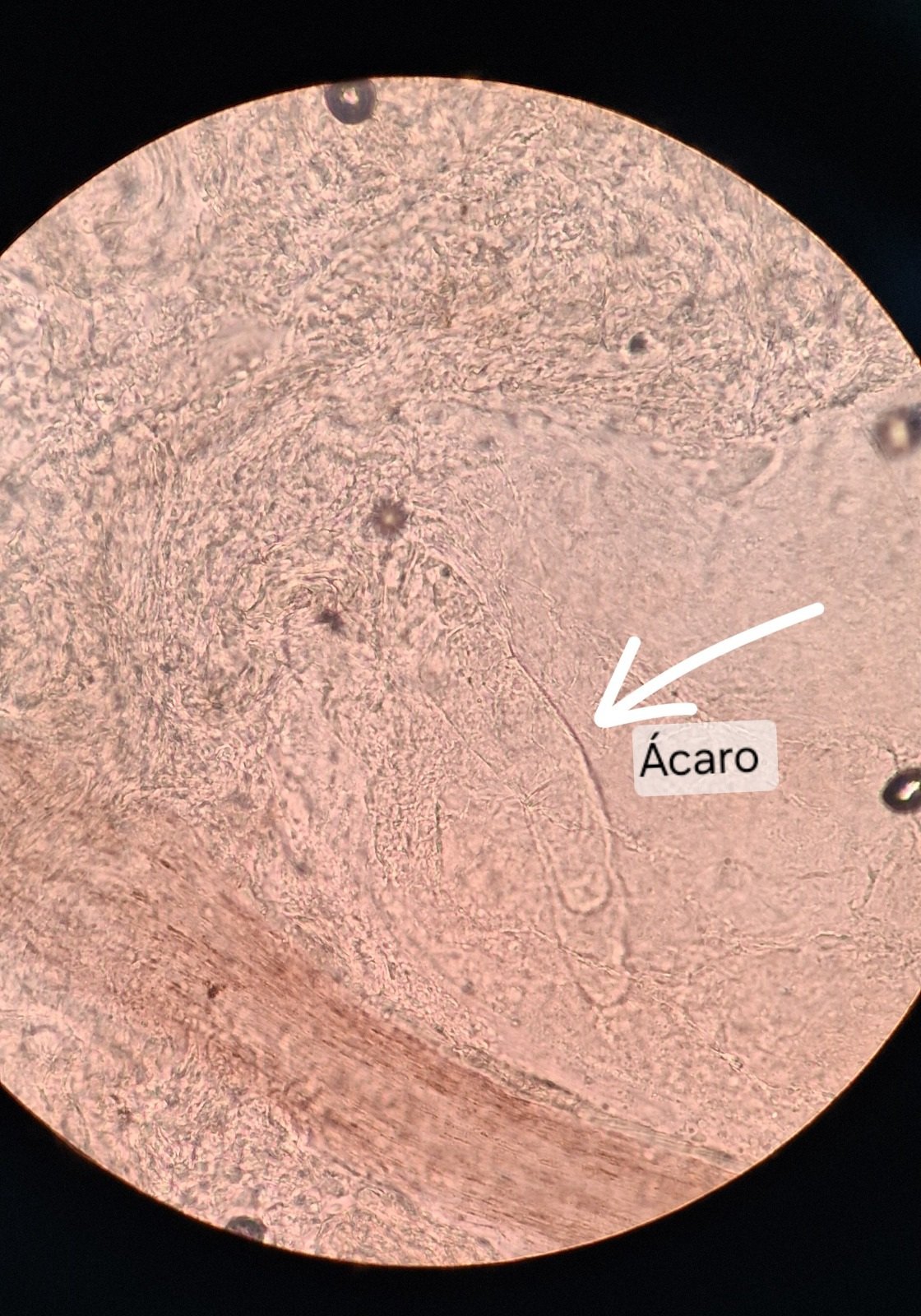 Caso clínico de Demodex y dermatitis seborreica