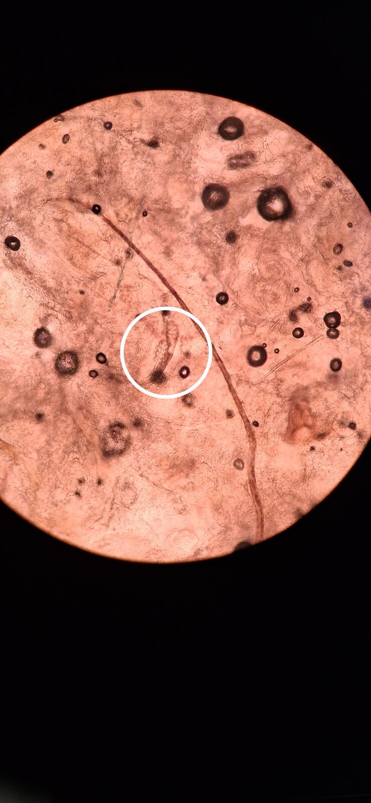 Demodex y rinofima: imagen antes