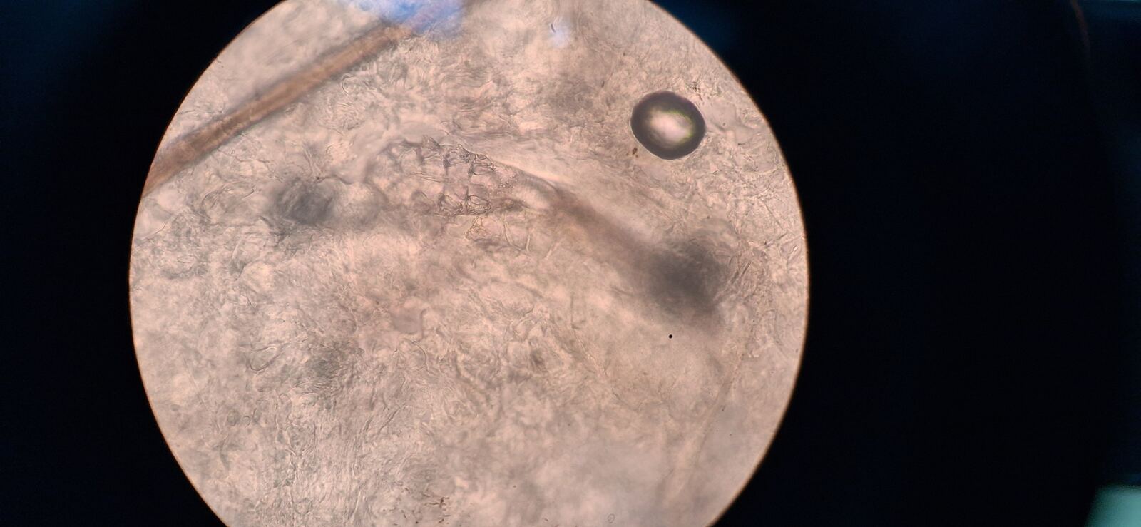 Demodex y rinofima: imagen después