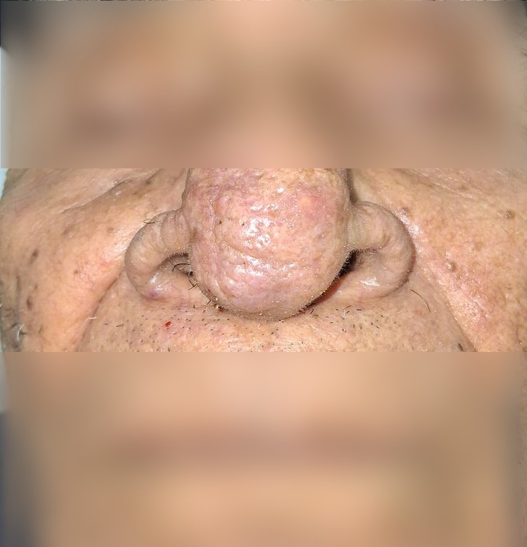 Caso clínico de Demodex y rinofima