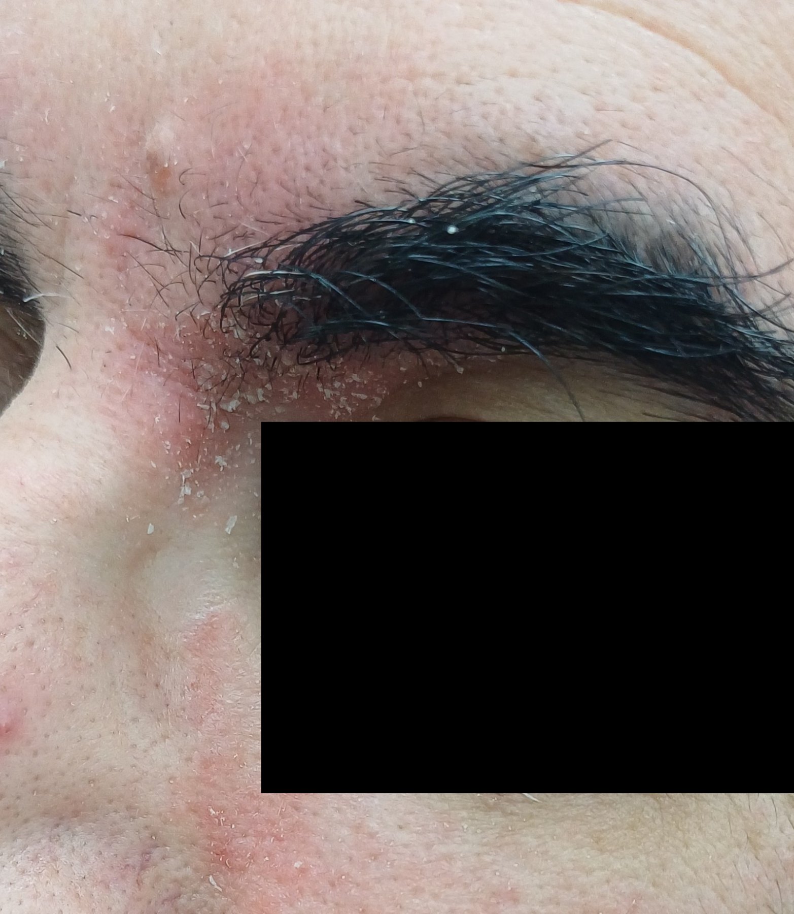 Demodex y rosácea: imagen antes
