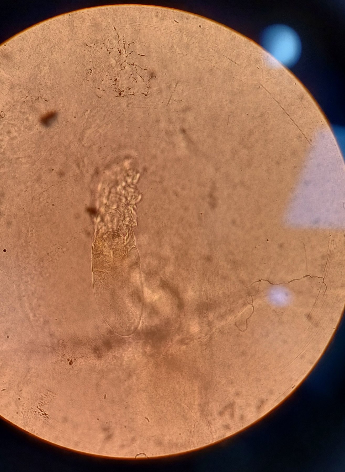Caso clínico de Demodex y rosácea