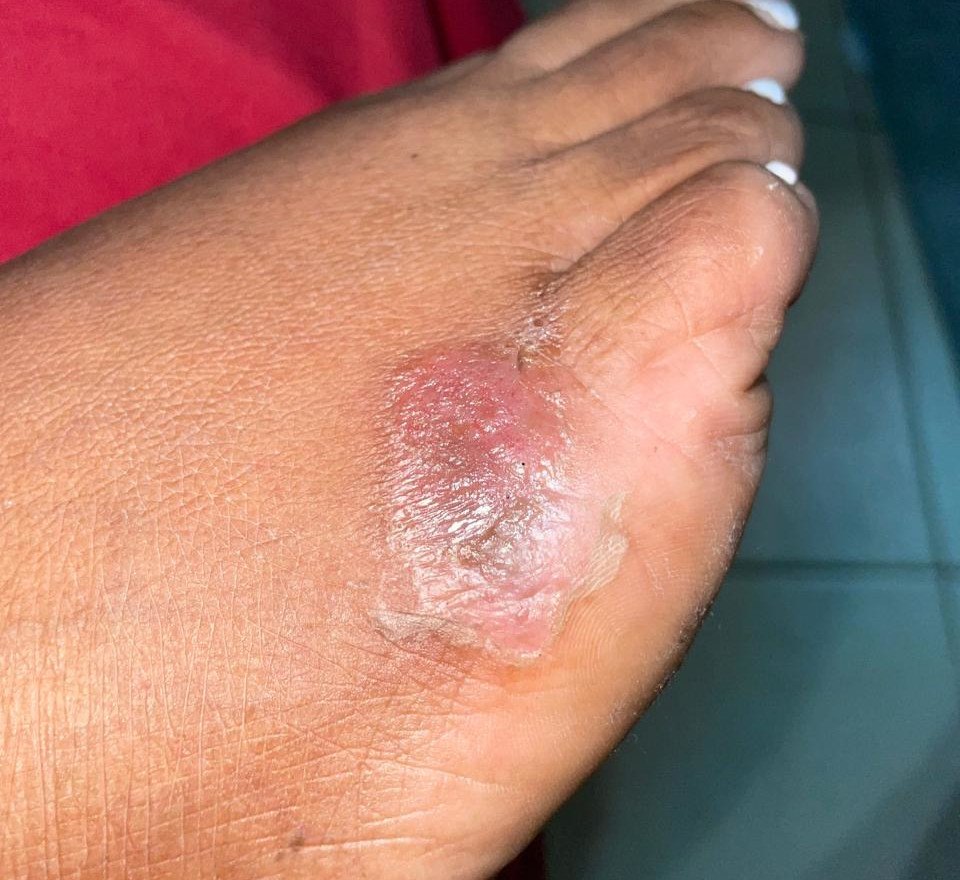Dermatitis: imagen antes