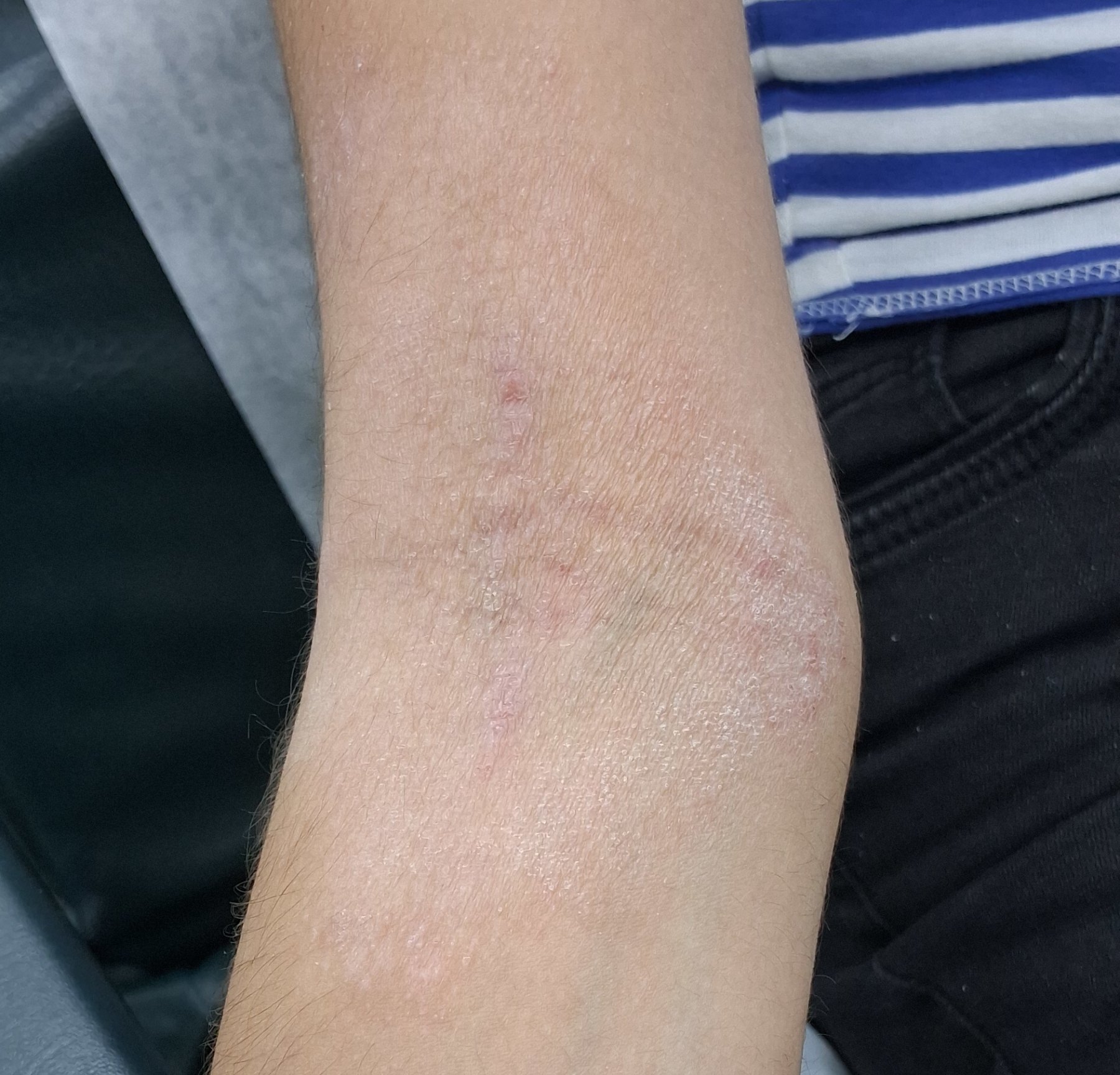 Dermatitis atópica: imagen antes