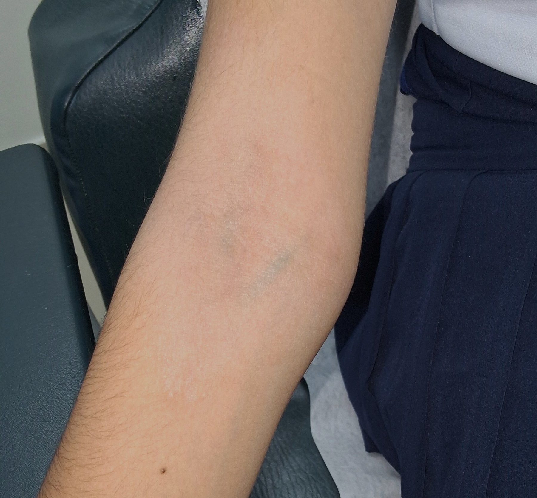 Dermatitis atópica: imagen después