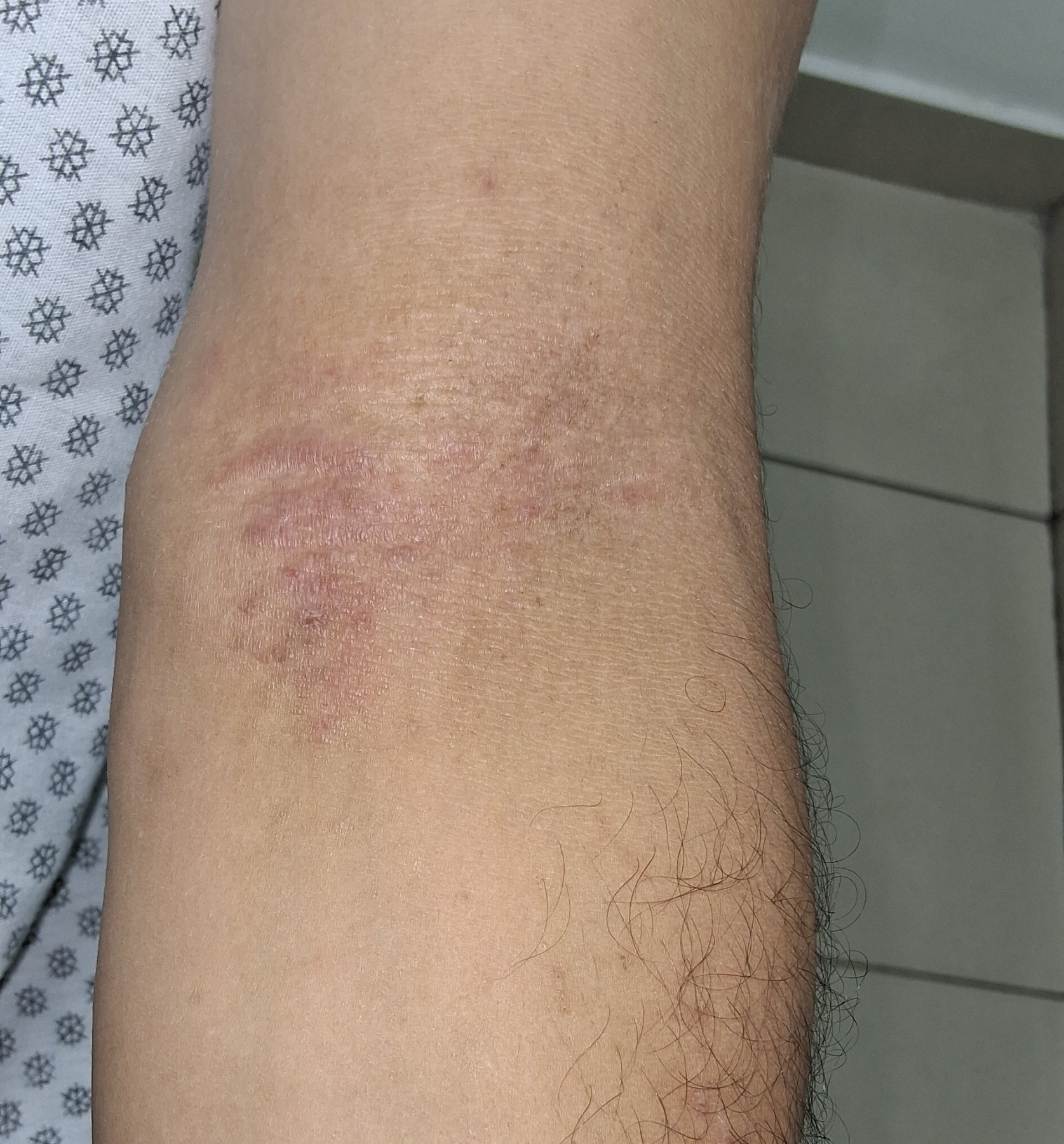 Caso clínico de Dermatitis atópica