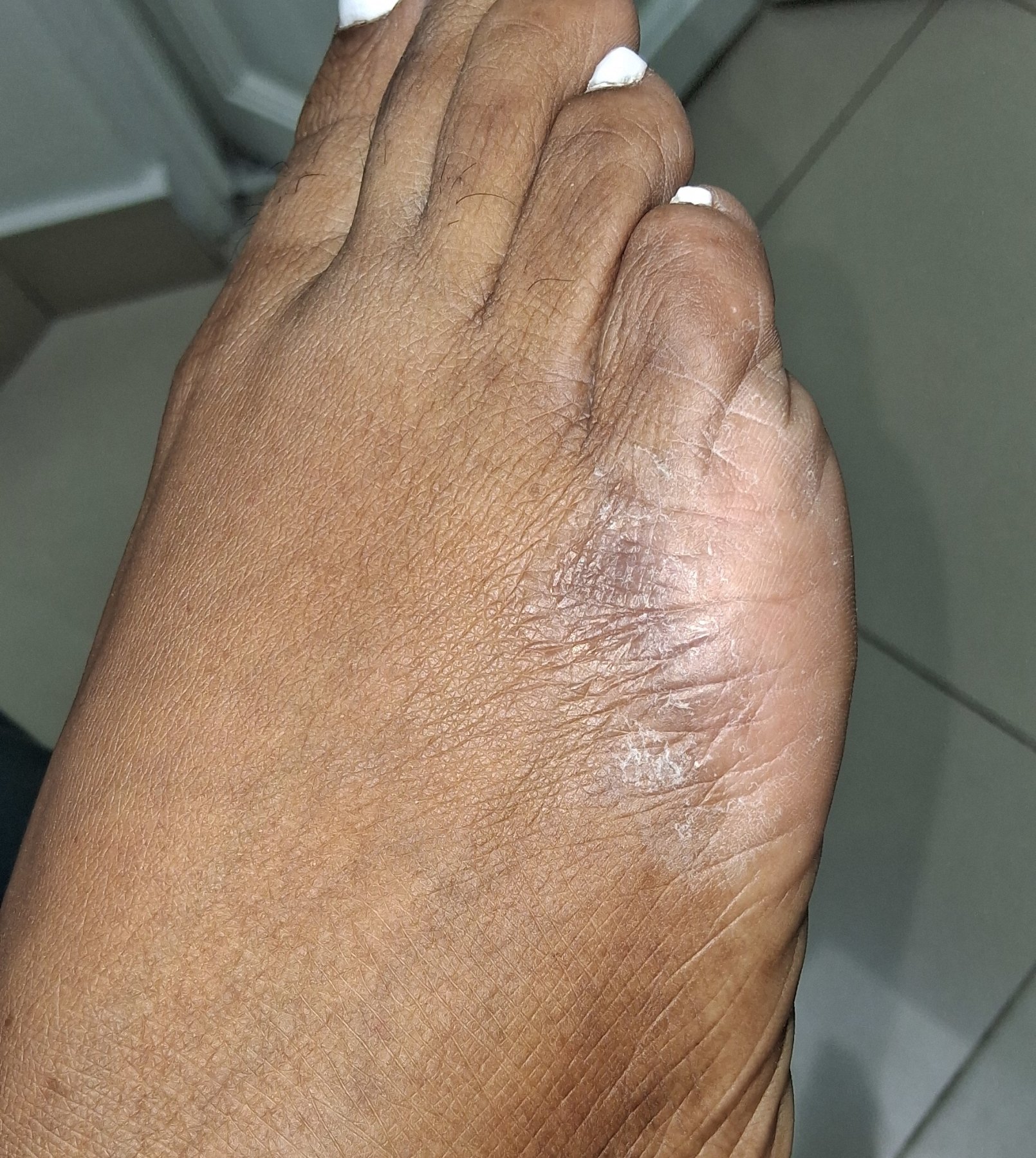 Dermatitis: imagen después