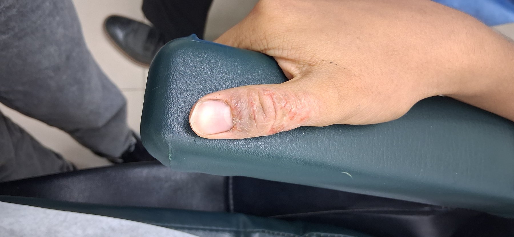 Dermatitis infectada: imagen antes