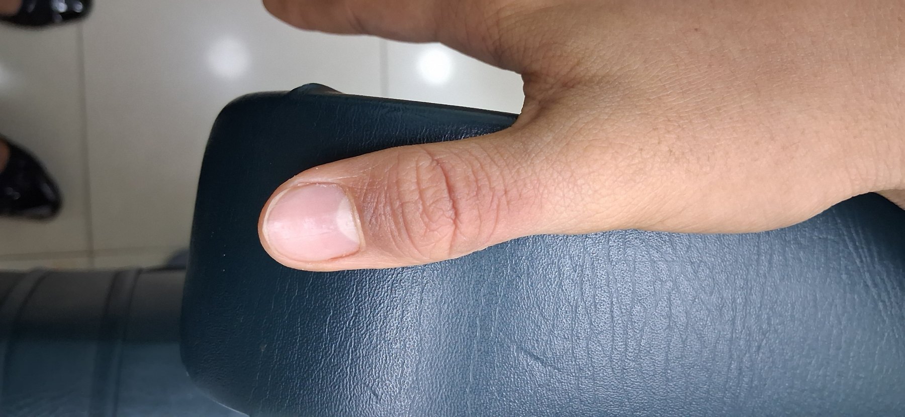 Dermatitis infectada: imagen después