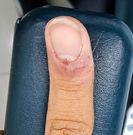 Caso clínico de Dermatitis infectada
