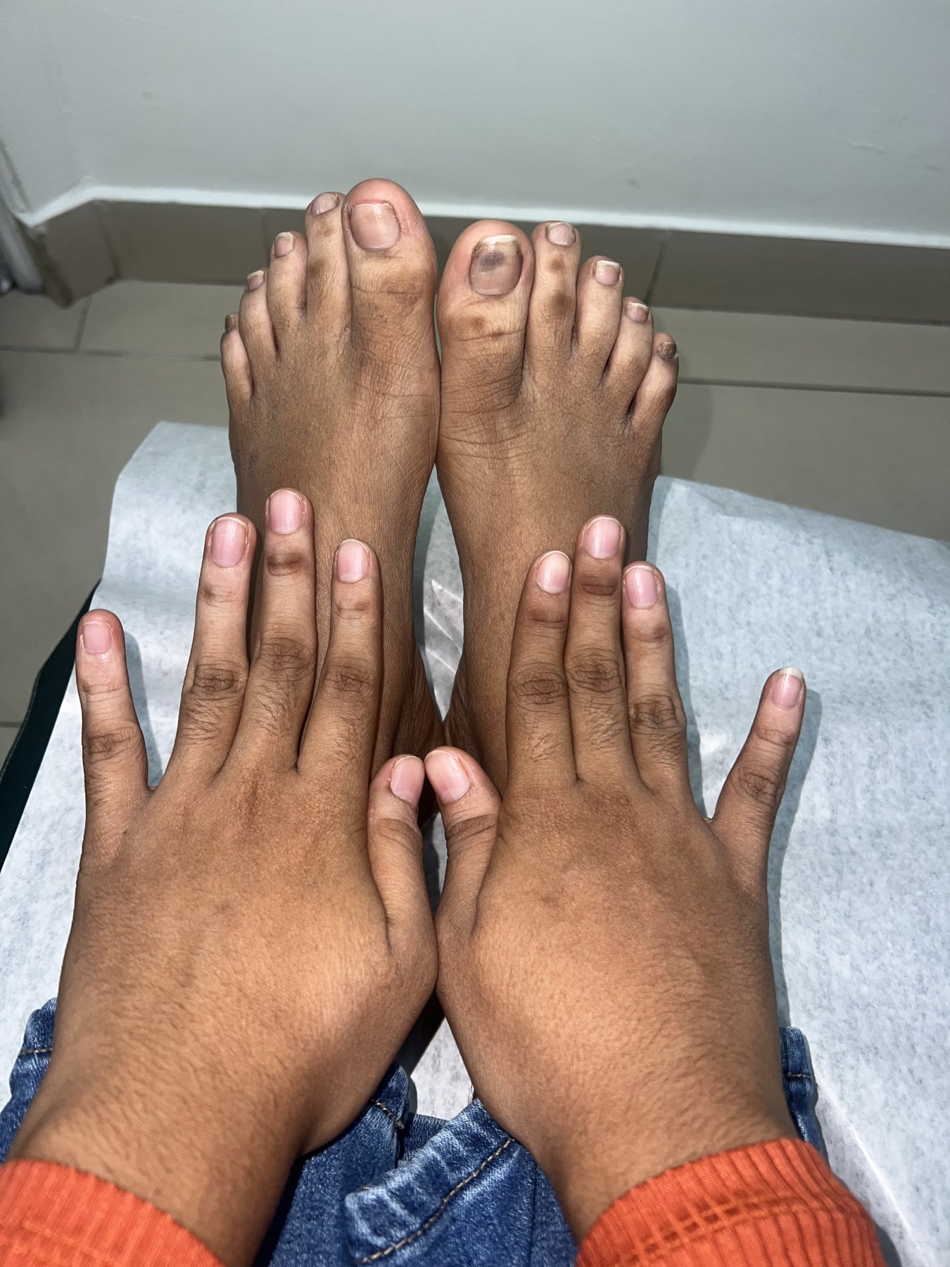 Dermatitis liquenoide vs psoriasis: imagen después