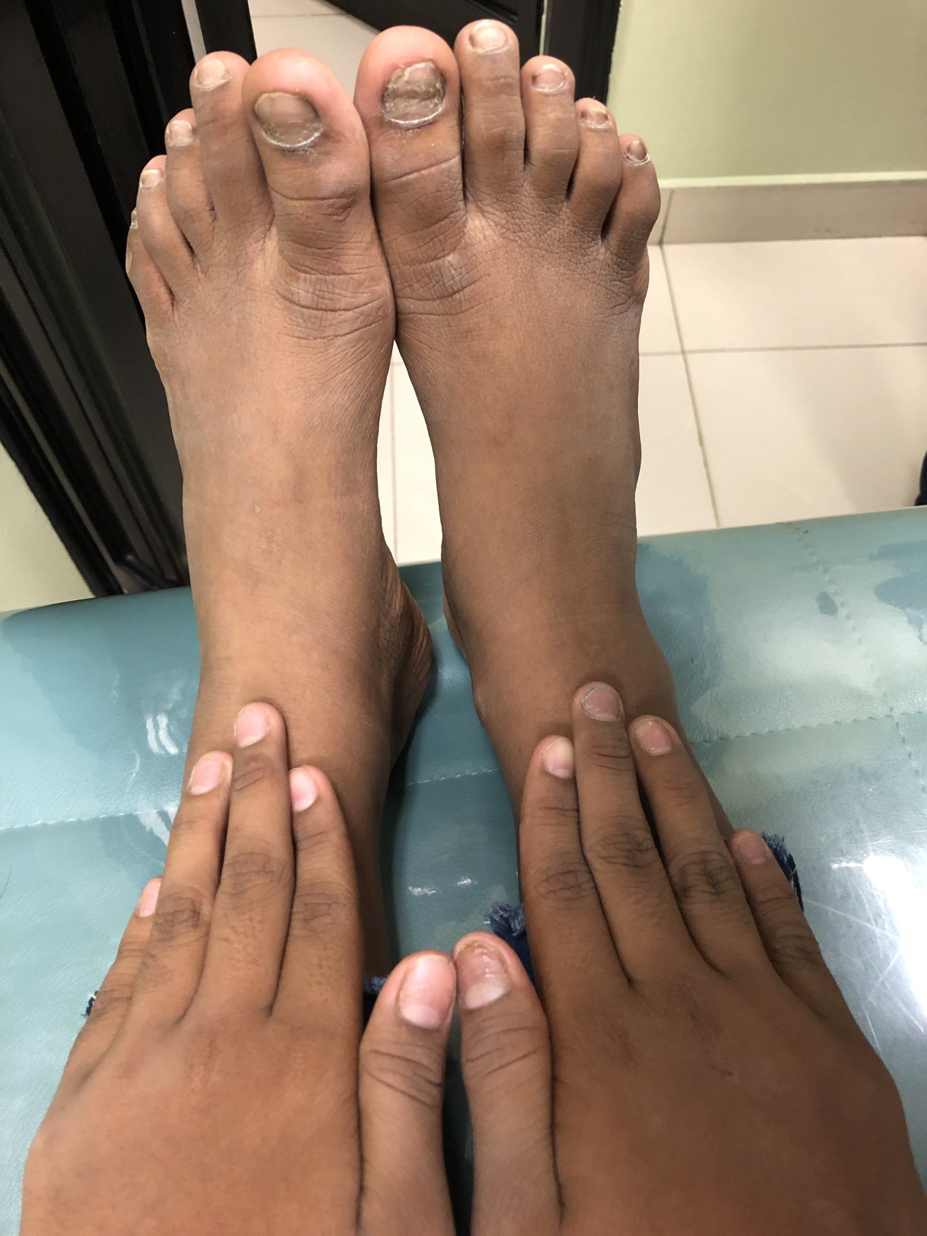 Caso clínico de Dermatitis liquenoide vs psoriasis