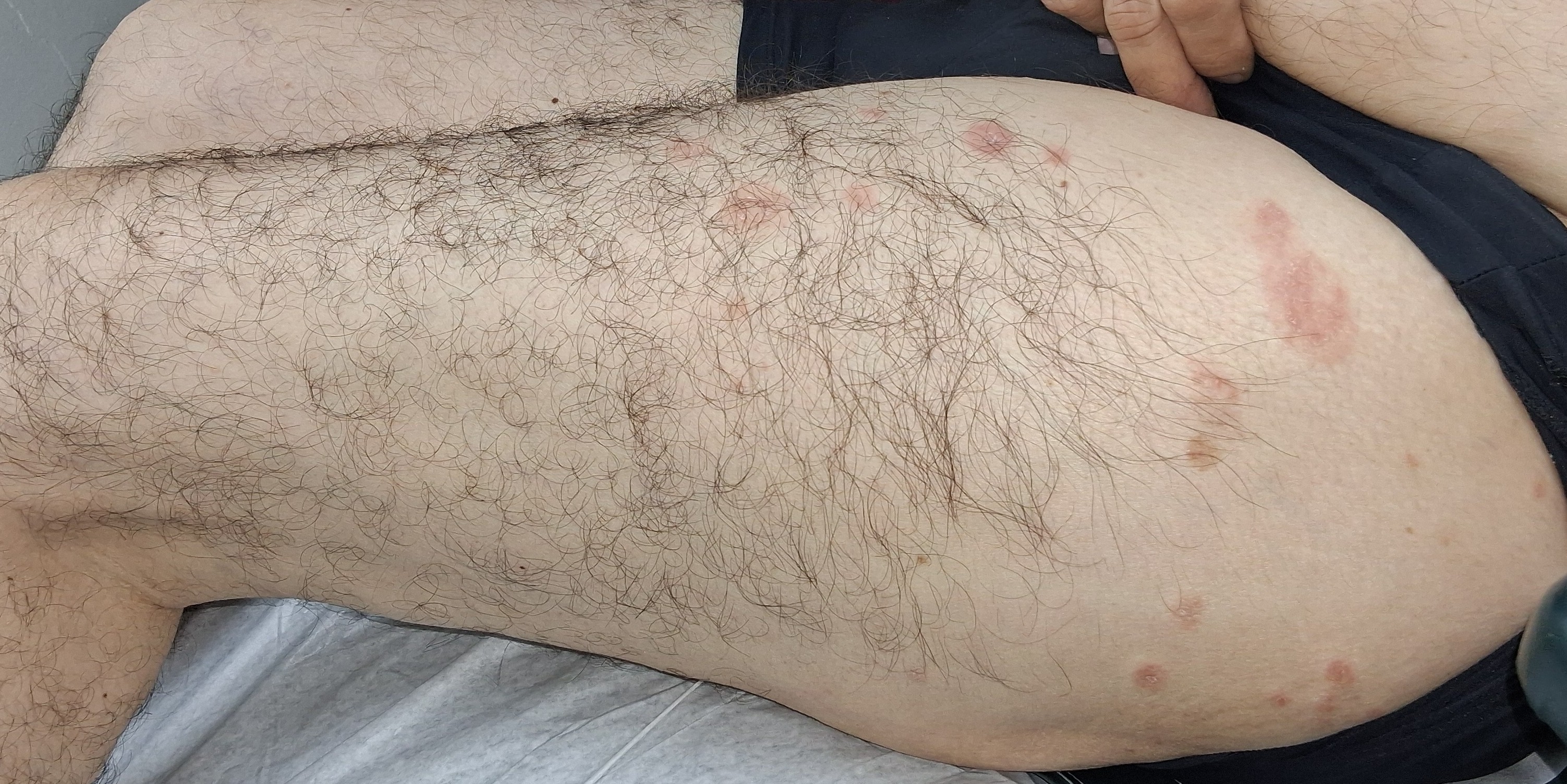 Dermatitis numular: imagen antes