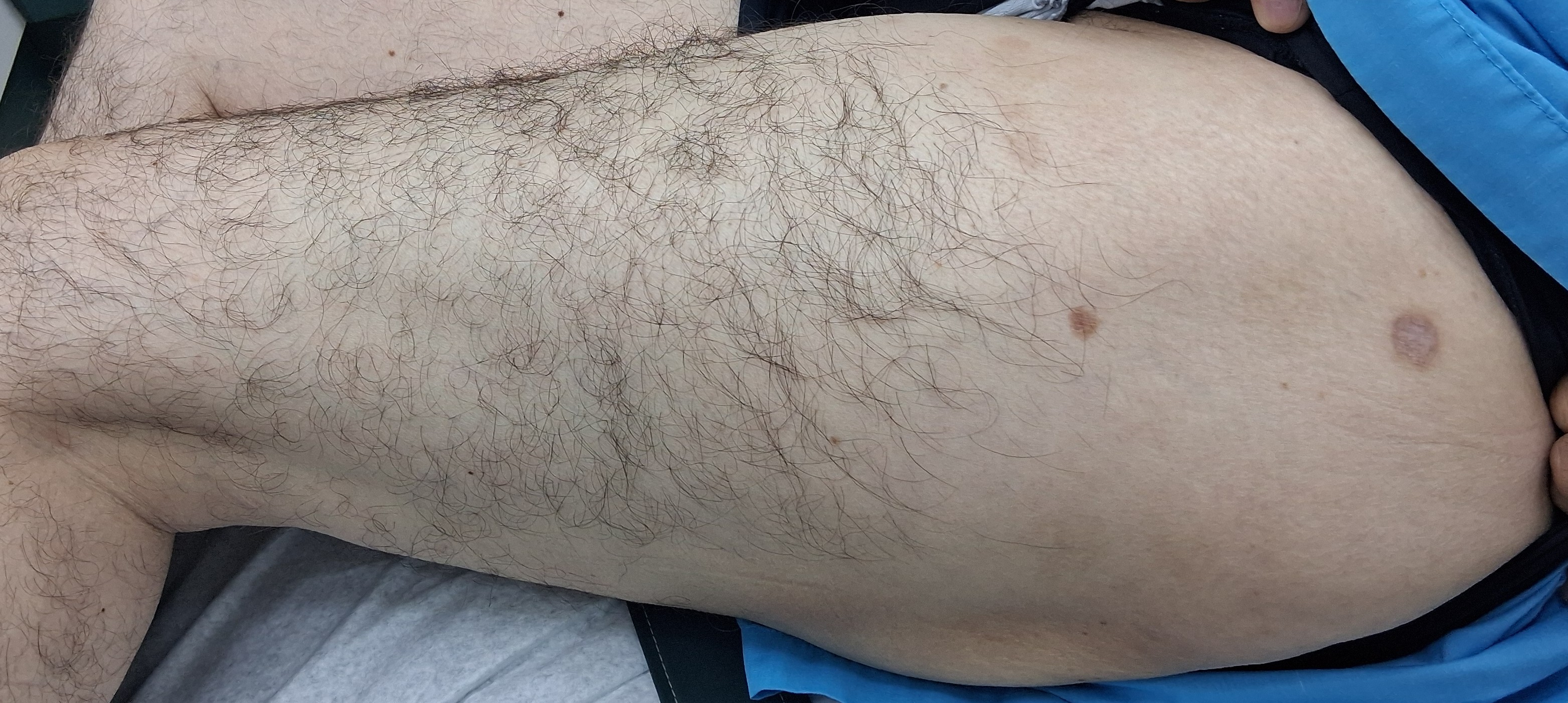 Dermatitis numular: imagen después
