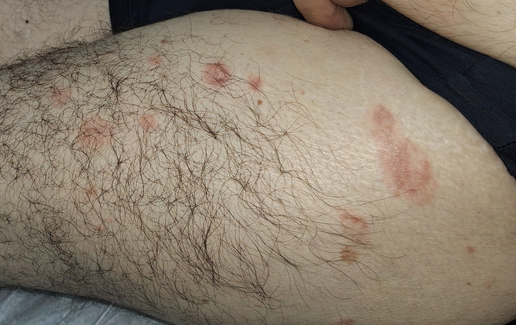 Caso clínico de Dermatitis numular