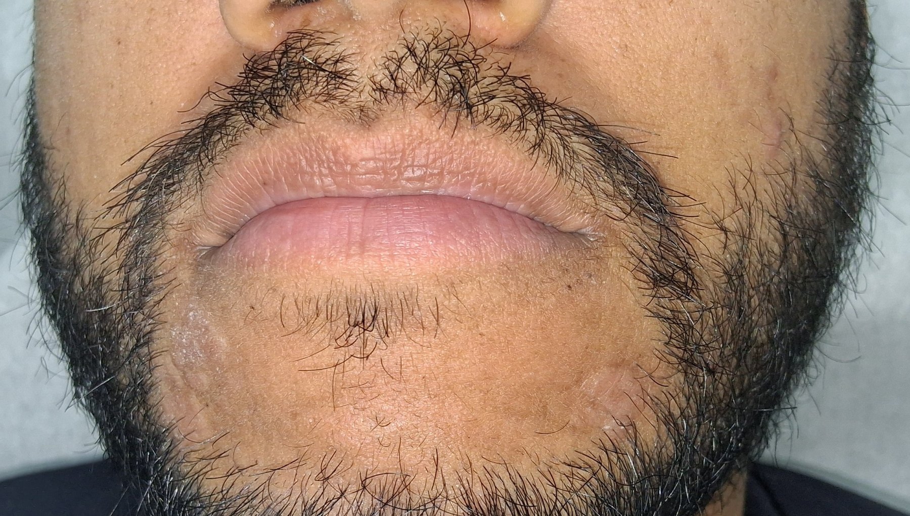 Dermatitis perioral: imagen antes