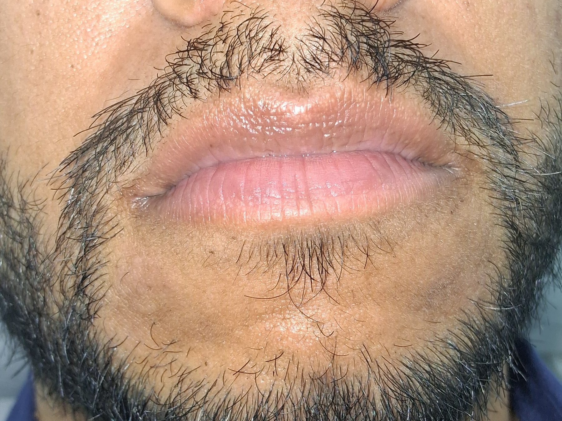 Dermatitis perioral: imagen después