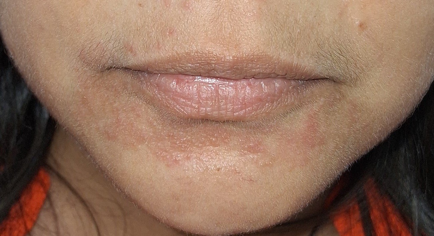 Dermatitis perioral: imagen antes