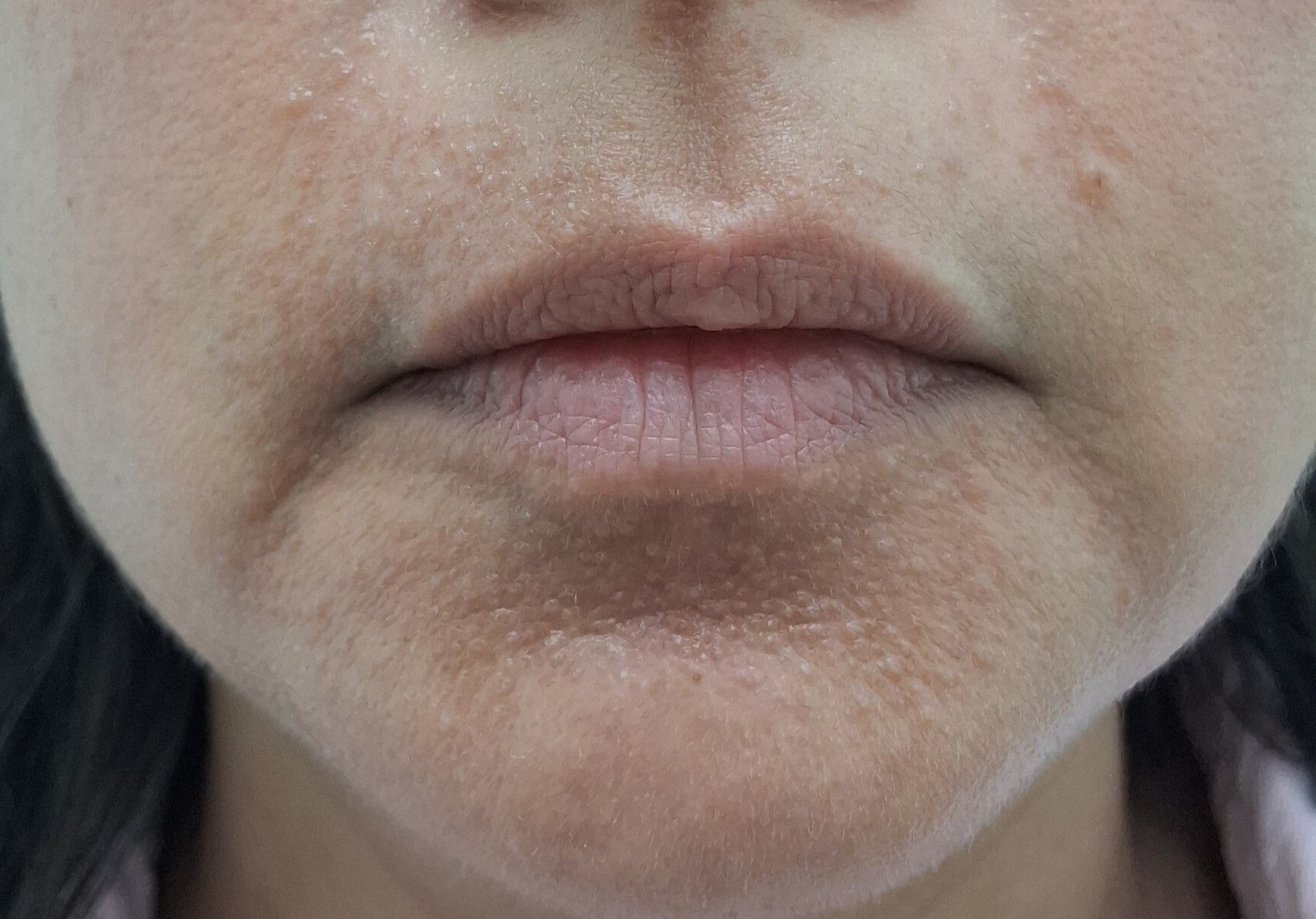 Dermatitis perioral: imagen después