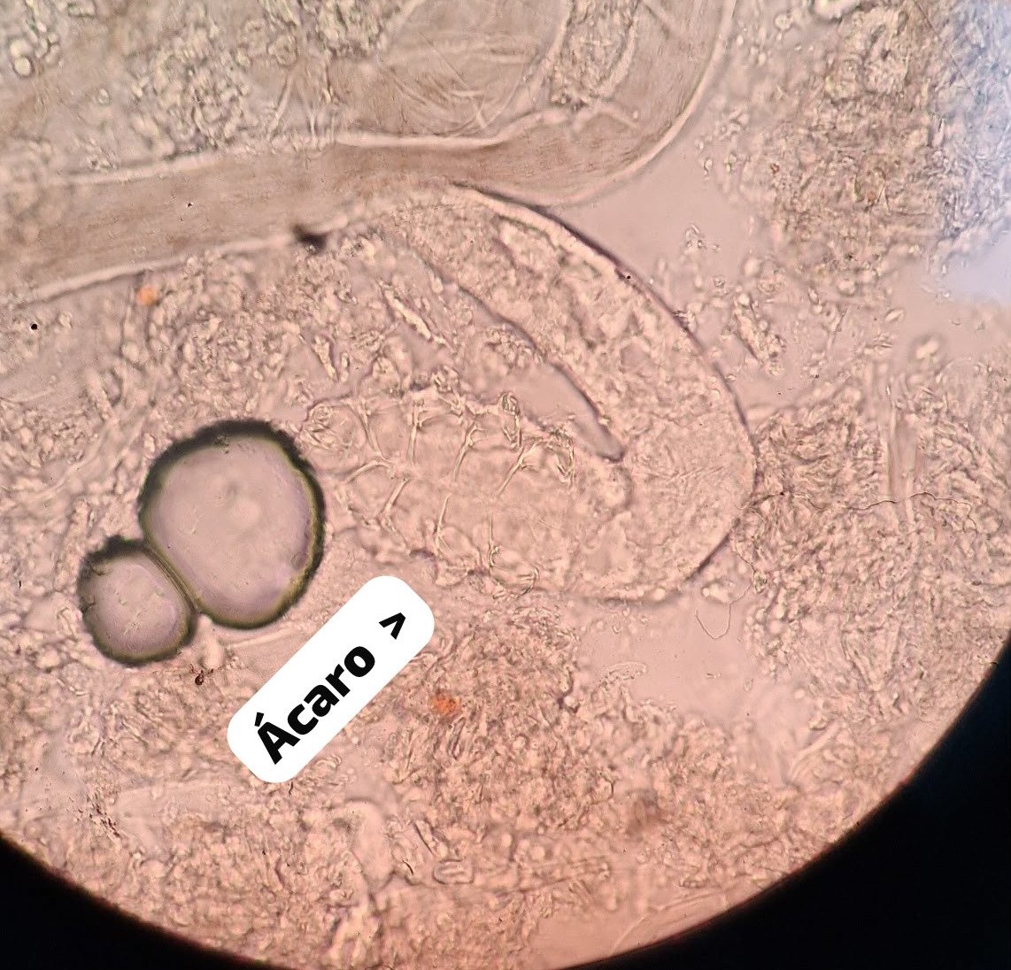Caso clínico de Dermatitis perioral