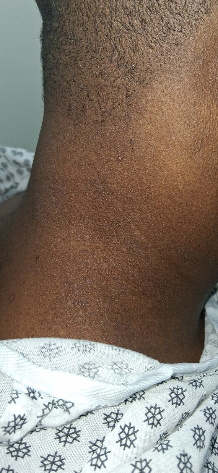 Dermatitis por contacto: imagen después